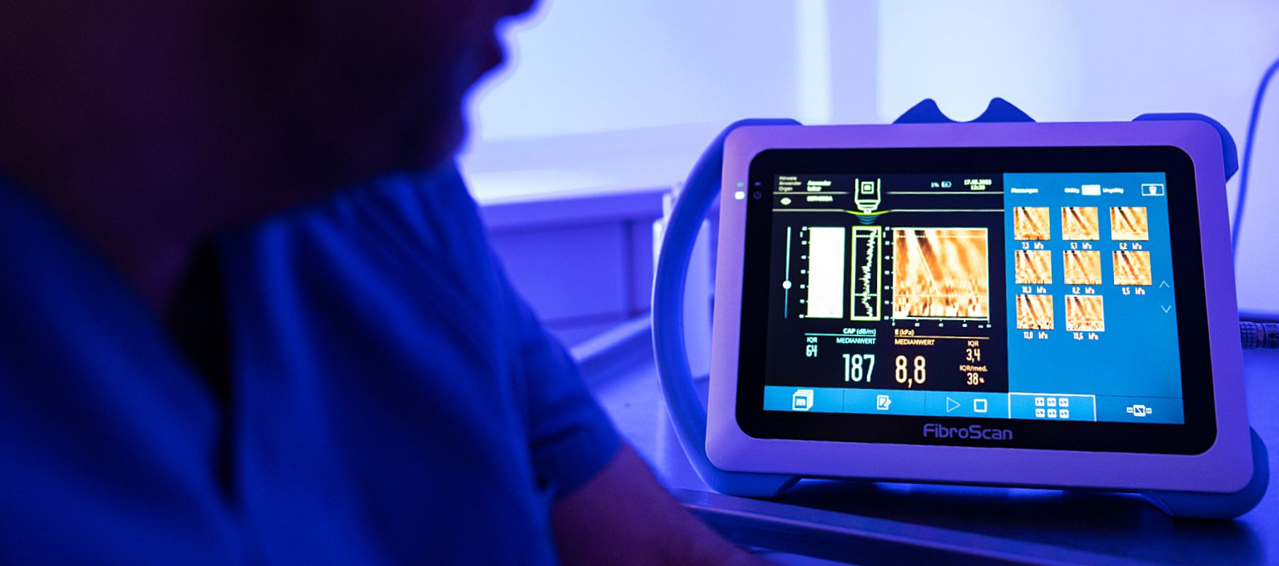 Ein Monitor zeigt die Ergebnisse einer FibroScan-Untersuchung, die zur Messung der Lebersteifigkeit bei möglichen Lebererkrankungen dient.